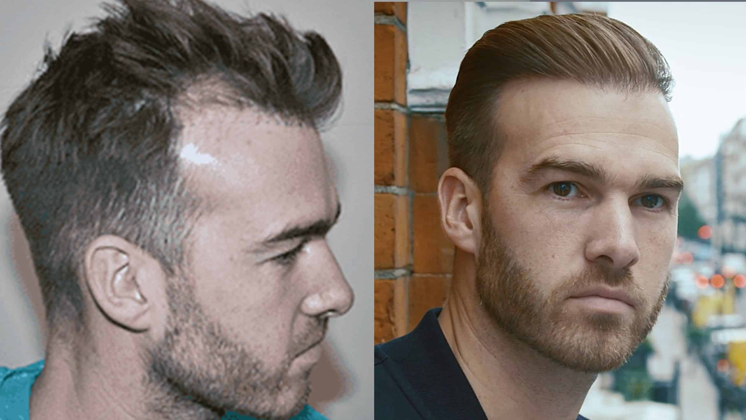 Hair Transplant