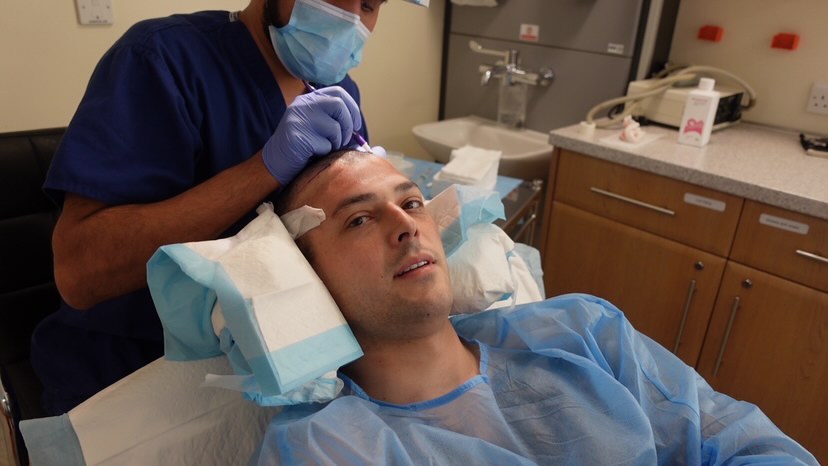 hair transplant uk